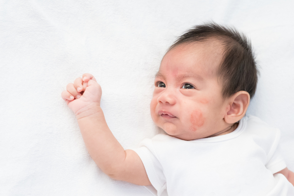 Breaking the Itch-Scratch Cycle: Hope For Babies with Eczema and Allergies